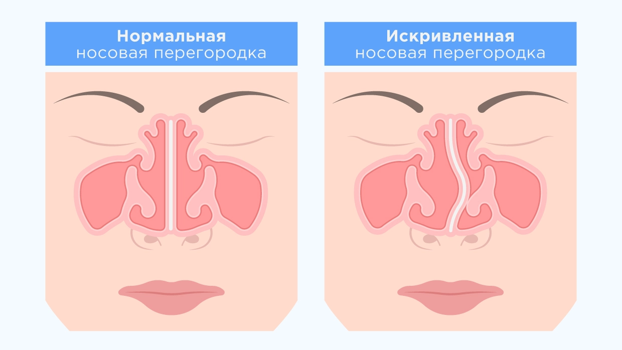 Пластика носовой перегородки